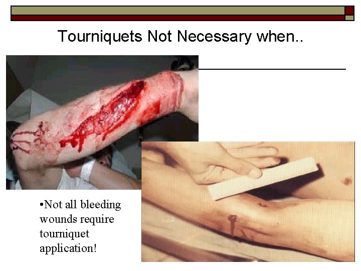 Tourniquets Not Necessary when. . • Not all bleeding wounds require tourniquet application! 