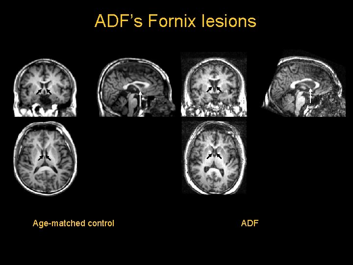 ADF’s Fornix lesions Age-matched control ADF ADF’s Fornix lesions Age-matched control ADF