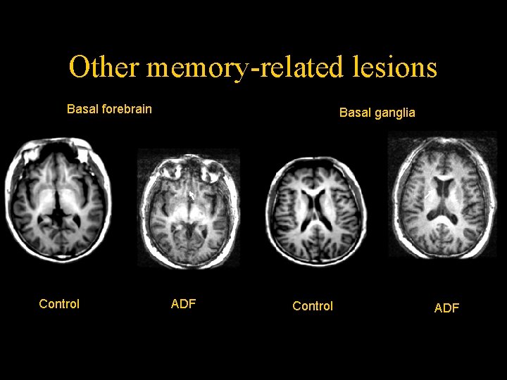 Other memory-related lesions Basal forebrain Control Basal ganglia ADF Control ADF Other memory-related lesions Basal forebrain Control Basal ganglia ADF Control ADF