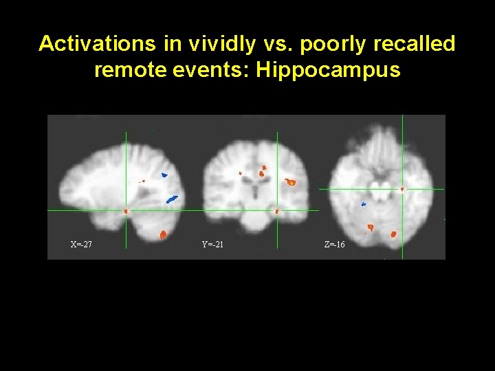 Activations in vividly vs. poorly recalled remote events: Hippocampus X=-27 Y=-21 Z=-16 Activations in vividly vs. poorly recalled remote events: Hippocampus X=-27 Y=-21 Z=-16