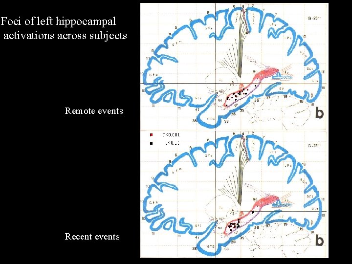 Foci of left hippocampal activations across subjects Remote events Recent events Foci of left hippocampal activations across subjects Remote events Recent events
