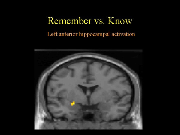 Remember vs. Know Left anterior hippocampal activation Remember vs. Know Left anterior hippocampal activation