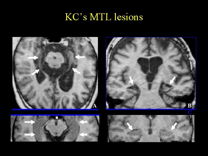 KC’s MTL lesions A B C KC’s MTL lesions A B C