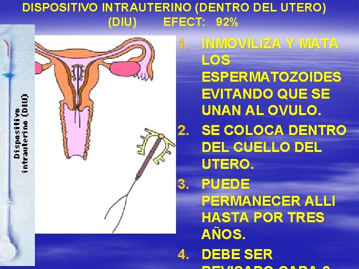 DISPOSITIVO INTRAUTERINO (DENTRO DEL UTERO) (DIU) EFECT: 92% 1. INMOVILIZA Y MATA LOS ESPERMATOZOIDES