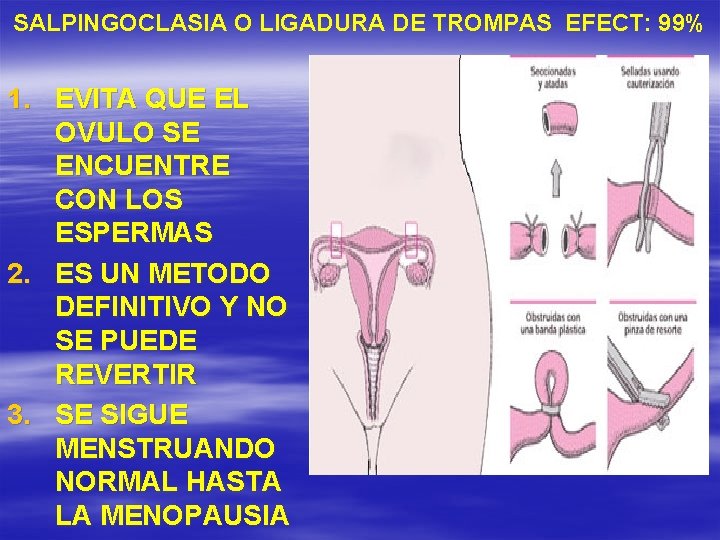 SALPINGOCLASIA O LIGADURA DE TROMPAS EFECT: 99% 1. EVITA QUE EL OVULO SE ENCUENTRE