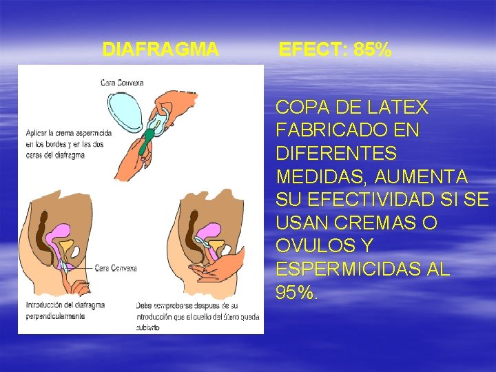 DIAFRAGMA EFECT: 85% COPA DE LATEX FABRICADO EN DIFERENTES MEDIDAS, AUMENTA SU EFECTIVIDAD SI