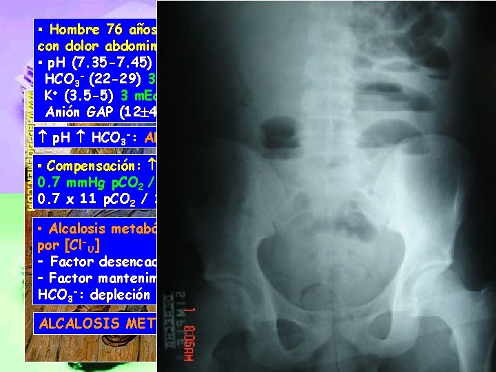 ▪ Hombre 76 años ingresa con antecedentes de ulcus gástrico con dolor abdominal y