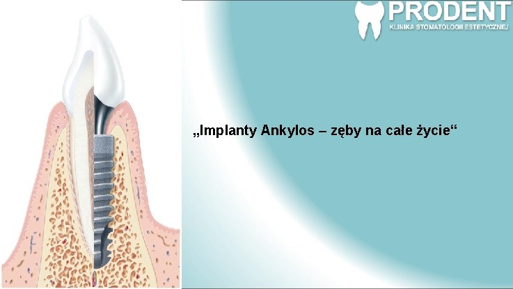 „Implanty Ankylos – zęby na całe życie“ 