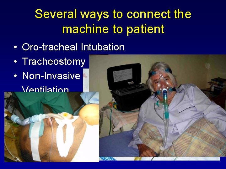 Several ways to connect the machine to patient • Oro-tracheal Intubation • Tracheostomy •