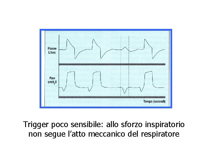 Trigger poco sensibile: allo sforzo inspiratorio non segue l’atto meccanico del respiratore 