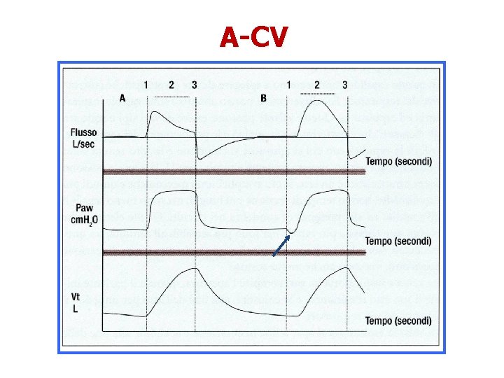 A-CV 