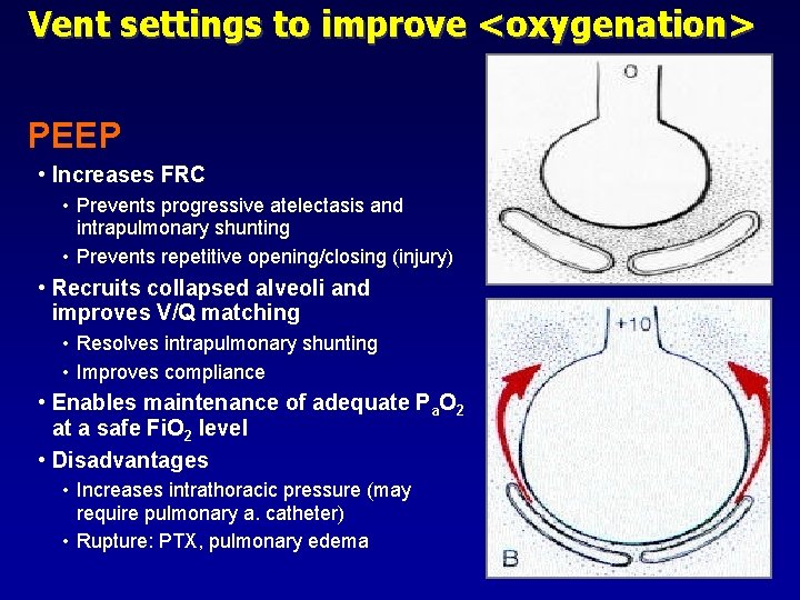 Vent settings to improve <oxygenation> PEEP • Increases FRC • Prevents progressive atelectasis and