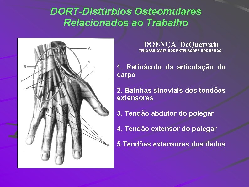 DORT-Distúrbios Osteomulares Relacionados ao Trabalho DOENÇA De. Quervain TENOSSINOVITE DOS EXTENSORES DOS DEDOS 1.