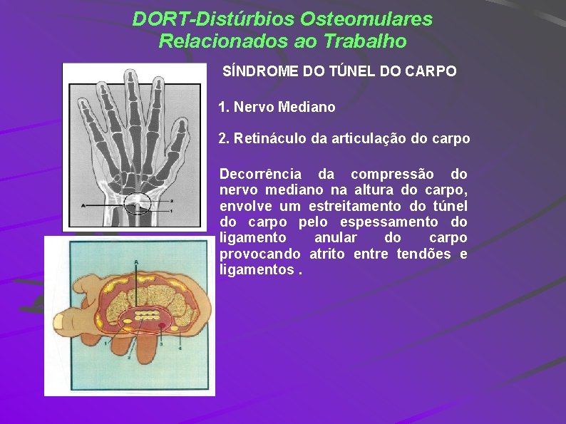 DORT-Distúrbios Osteomulares Relacionados ao Trabalho SÍNDROME DO TÚNEL DO CARPO 1. Nervo Mediano 2.