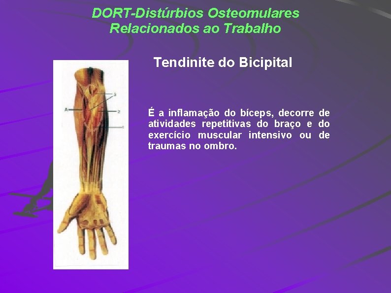 DORT-Distúrbios Osteomulares Relacionados ao Trabalho Tendinite do Bicipital É a inflamação do bíceps, decorre