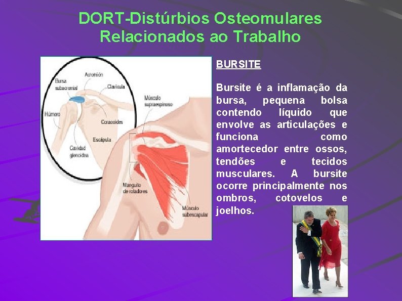 DORT-Distúrbios Osteomulares Relacionados ao Trabalho BURSITE Bursite é a inflamação da bursa, pequena bolsa
