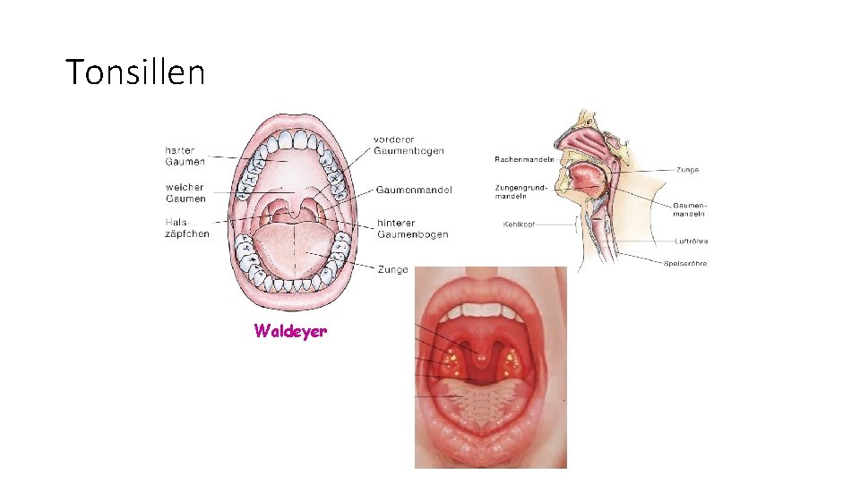 Tonsillen Waldeyer 