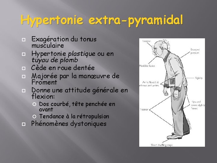 Hypertonie extra-pyramidal Exagération du tonus musculaire Hypertonie plastique ou en tuyau de plomb Cède