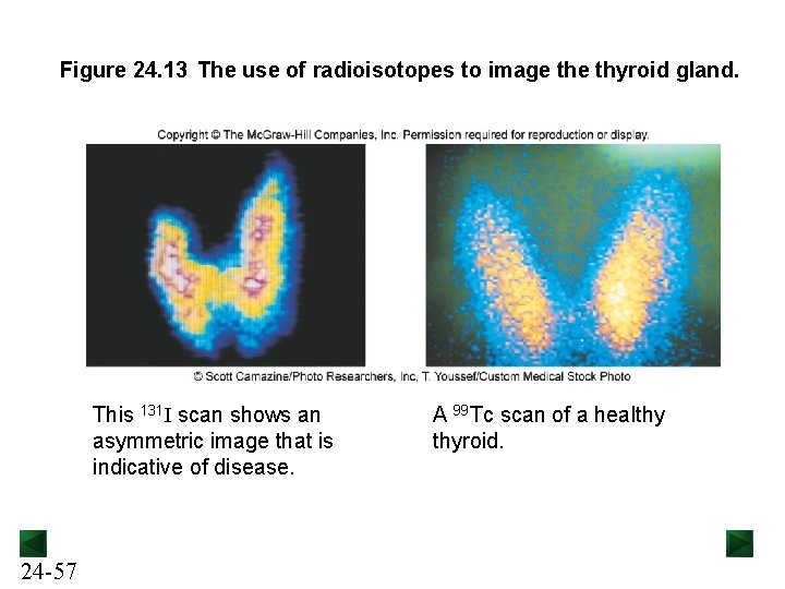 Figure 24. 13 The use of radioisotopes to image thyroid gland. This 131 I