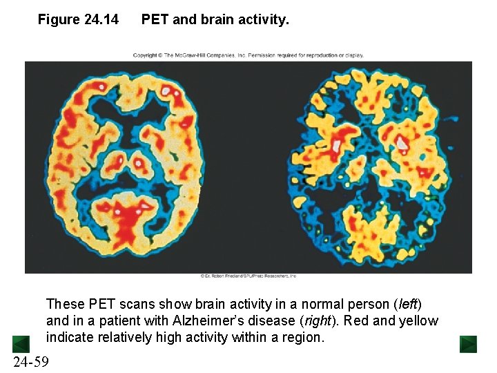 Figure 24. 14 PET and brain activity. These PET scans show brain activity in