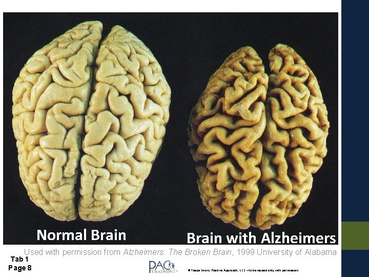 Normal Brain with Alzheimers Used with permission from Alzheimers: The Broken Brain, 1999 University