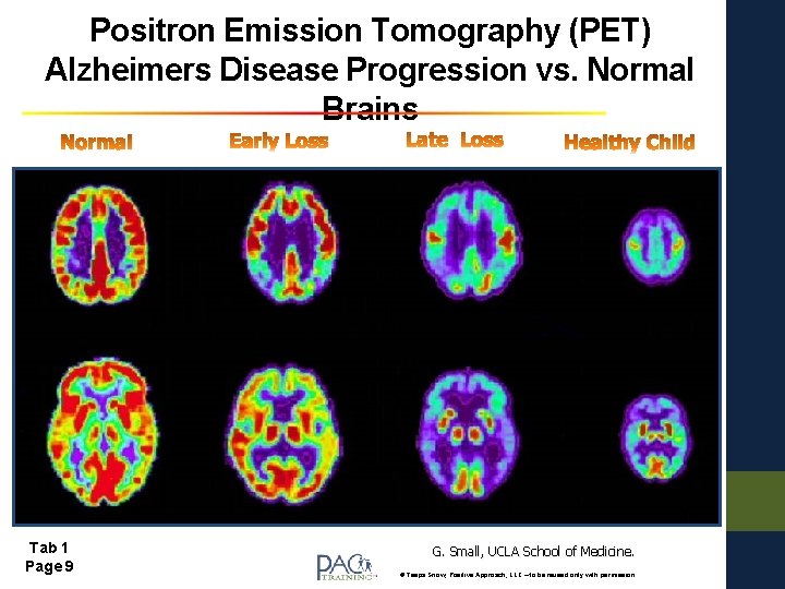 Positron Emission Tomography (PET) Alzheimers Disease Progression vs. Normal Brains Tab 1 Page 9