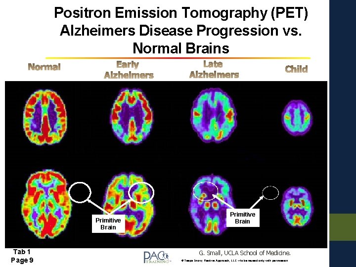 Positron Emission Tomography (PET) Alzheimers Disease Progression vs. Normal Brains Primitive Brain Tab 1