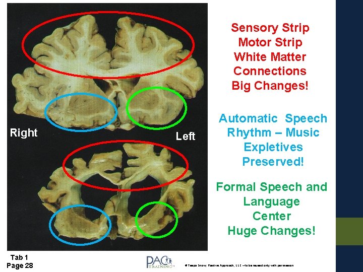 Sensory Strip Motor Strip White Matter Connections Big Changes! Right Left Automatic Speech Rhythm