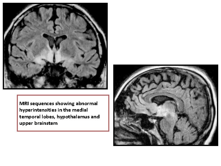 MRI sequences showing abnormal hyperintensities in the medial temporal lobes, hypothalamus and upper brainstem