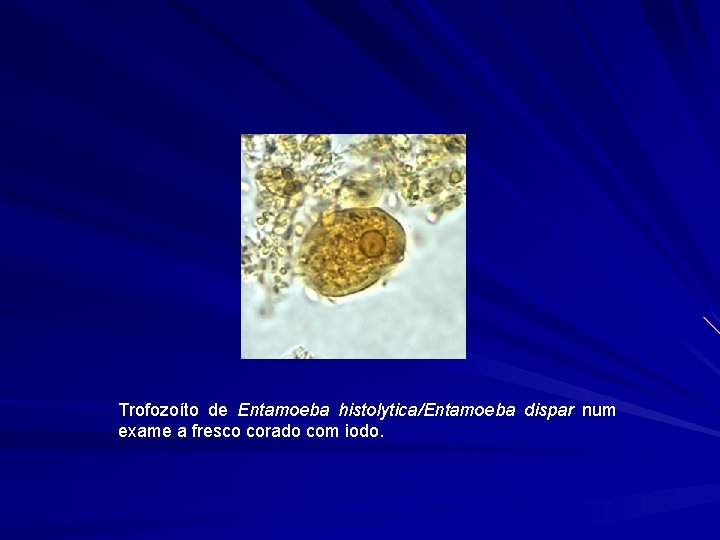 Trofozoíto de Entamoeba histolytica/Entamoeba dispar num exame a fresco corado com iodo. 