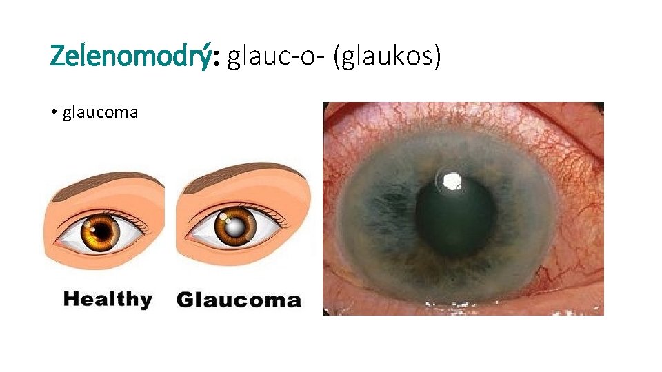 Zelenomodrý: glauc-o- (glaukos) • glaucoma 