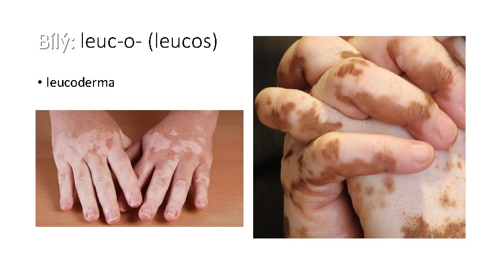 Bílý: leuc-o- (leucos) • leucoderma 