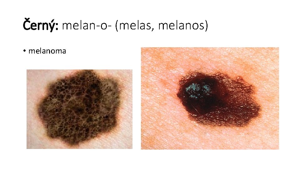 Černý: melan-o- (melas, melanos) • melanoma 