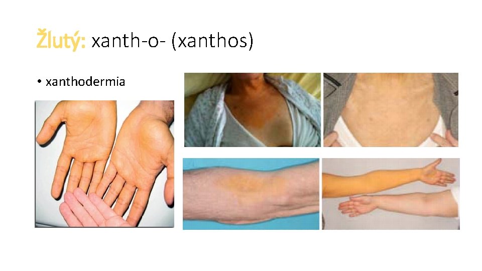 Žlutý: xanth-o- (xanthos) • xanthodermia 