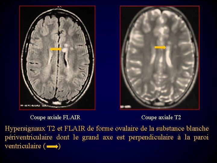 Coupe axiale FLAIR Coupe axiale T 2 Hypersignaux T 2 et FLAIR de forme