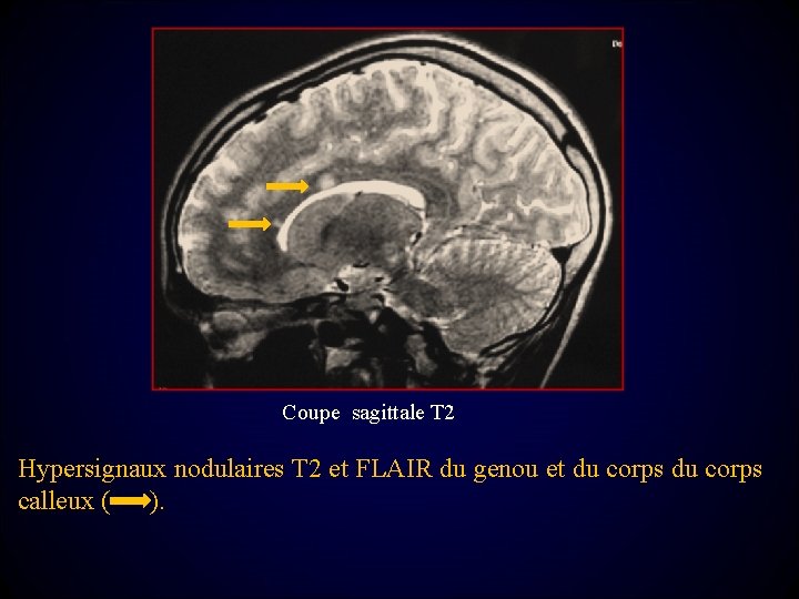 Coupe sagittale T 2 Hypersignaux nodulaires T 2 et FLAIR du genou et du