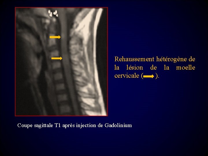 Rehaussement hétérogène de la lésion de la moelle cervicale ( ). Coupe sagittale T