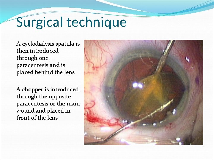 Surgical technique A cyclodialysis spatula is then introduced through one paracentesis and is placed
