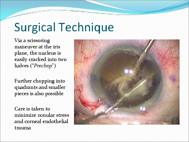 Surgical Technique Via a scissoring maneuver at the iris plane, the nucleus is easily