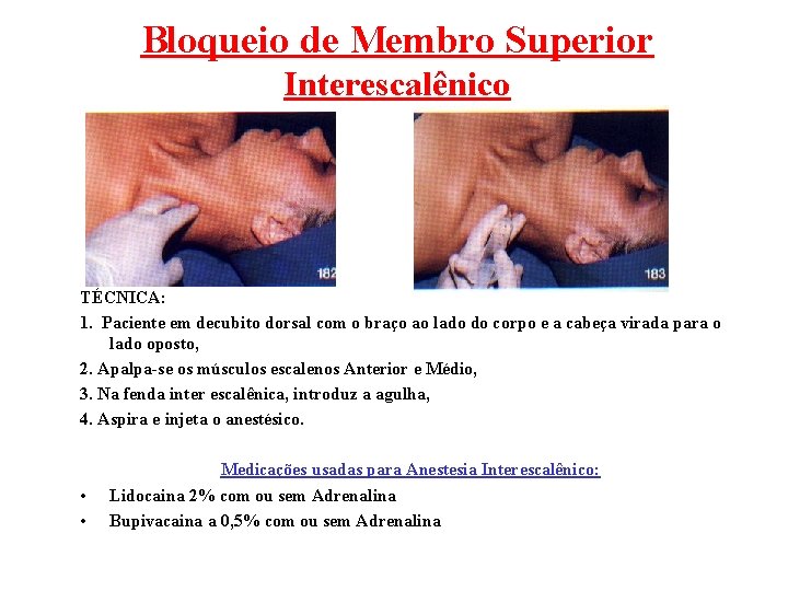 Bloqueio de Membro Superior Interescalênico TÉCNICA: 1. Paciente em decubito dorsal com o braço