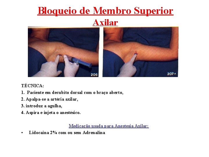 Bloqueio de Membro Superior Axilar TÉCNICA: 1. Paciente em decubito dorsal com o braço