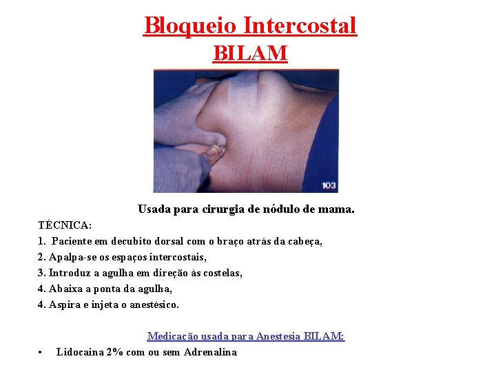 Bloqueio Intercostal BILAM Usada para cirurgia de nódulo de mama. TÉCNICA: 1. Paciente em
