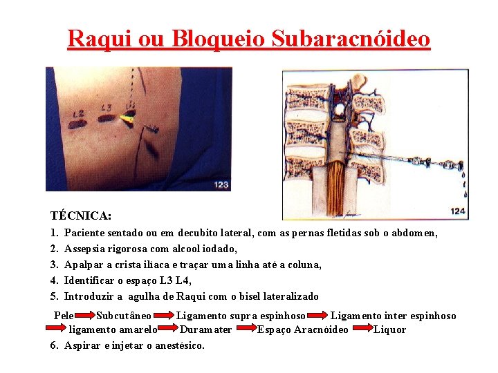 Raqui ou Bloqueio Subaracnóideo TÉCNICA: 1. 2. 3. 4. 5. Paciente sentado ou em