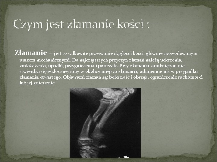 Czym jest złamanie kości : Złamanie – jest to całkowite przerwanie ciągłości kości, głównie Czym jest złamanie kości : Złamanie – jest to całkowite przerwanie ciągłości kości, głównie