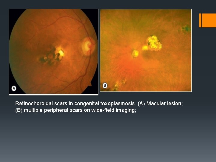 Retinochoroidal scars in congenital toxoplasmosis. (A) Macular lesion; (B) multiple peripheral scars on wide-field