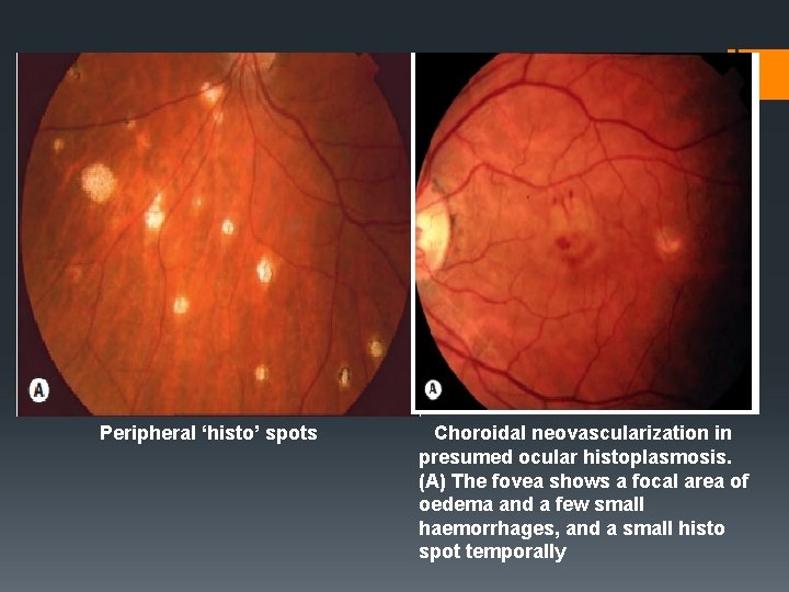 Peripheral ‘histo’ spots   Choroidal neovascularization in presumed ocular histoplasmosis. (A) The fovea shows
