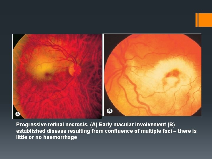 Progressive retinal necrosis. (A) Early macular involvement (B) established disease resulting from confluence of