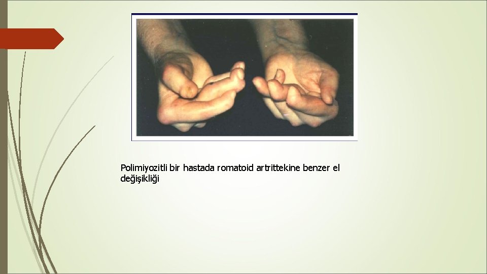 Polimiyozitli bir hastada romatoid artrittekine benzer el değişikliği Polimiyozitli bir hastada romatoid artrittekine benzer el değişikliği