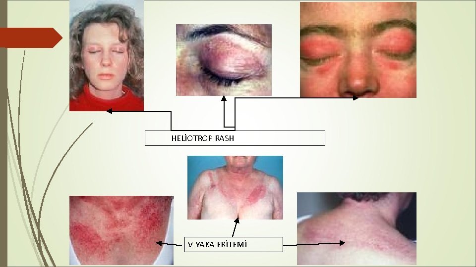 HELİOTROP RASH V YAKA ERİTEMİ HELİOTROP RASH V YAKA ERİTEMİ