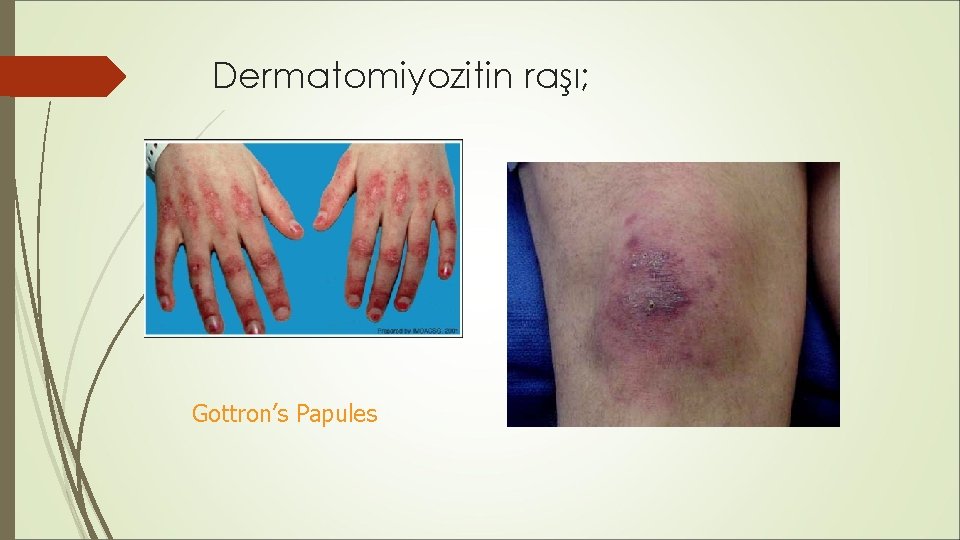Dermatomiyozitin raşı; Gottron’s Papules Dermatomiyozitin raşı; Gottron’s Papules